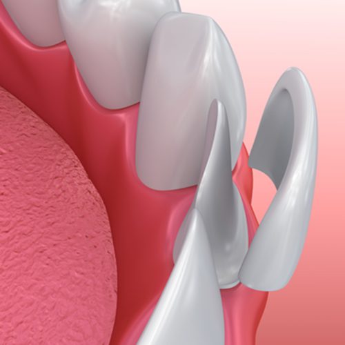 Porcelain Veneers