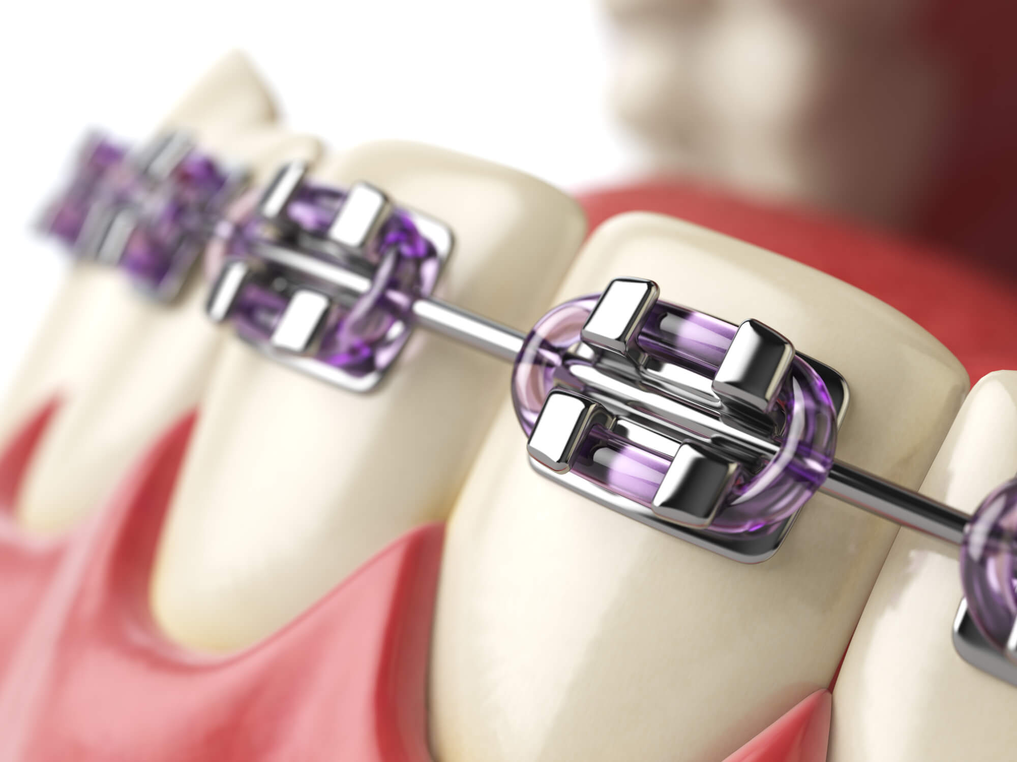 where can i get braces in boynton beach fl?