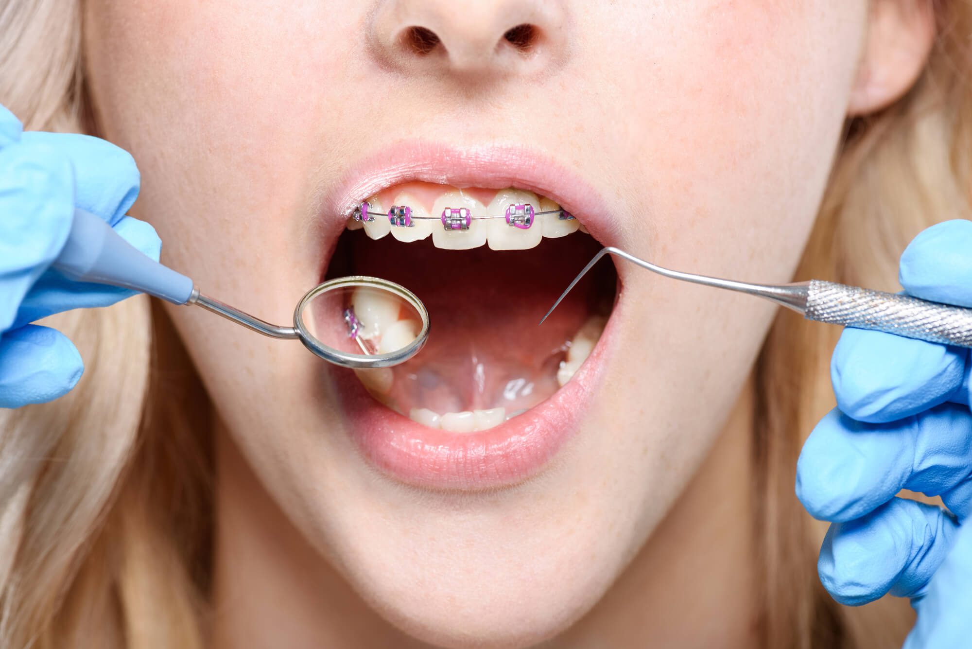 where can i get braces in boynton beach fl?