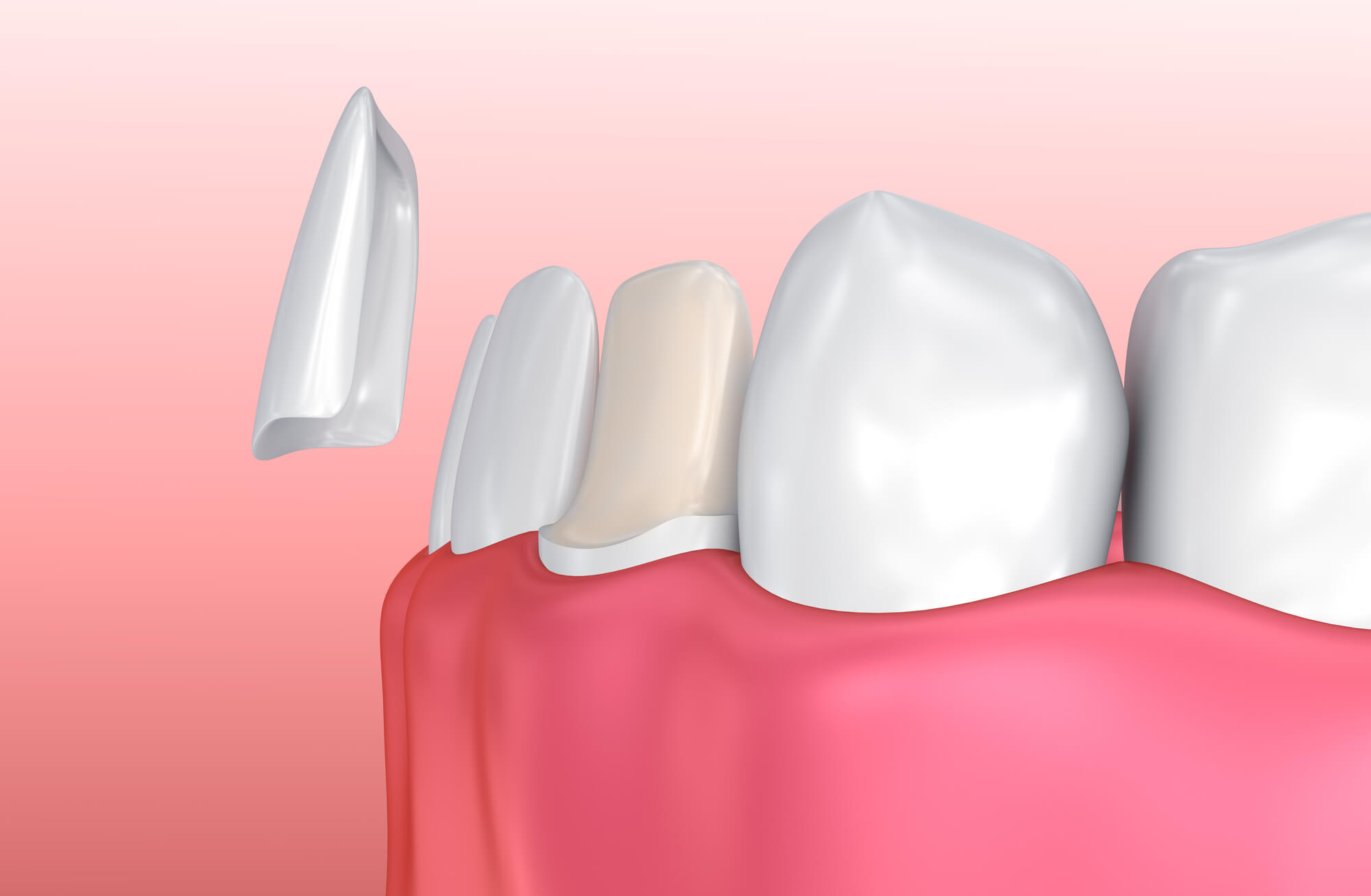 where can I find Boca Raton veneers?