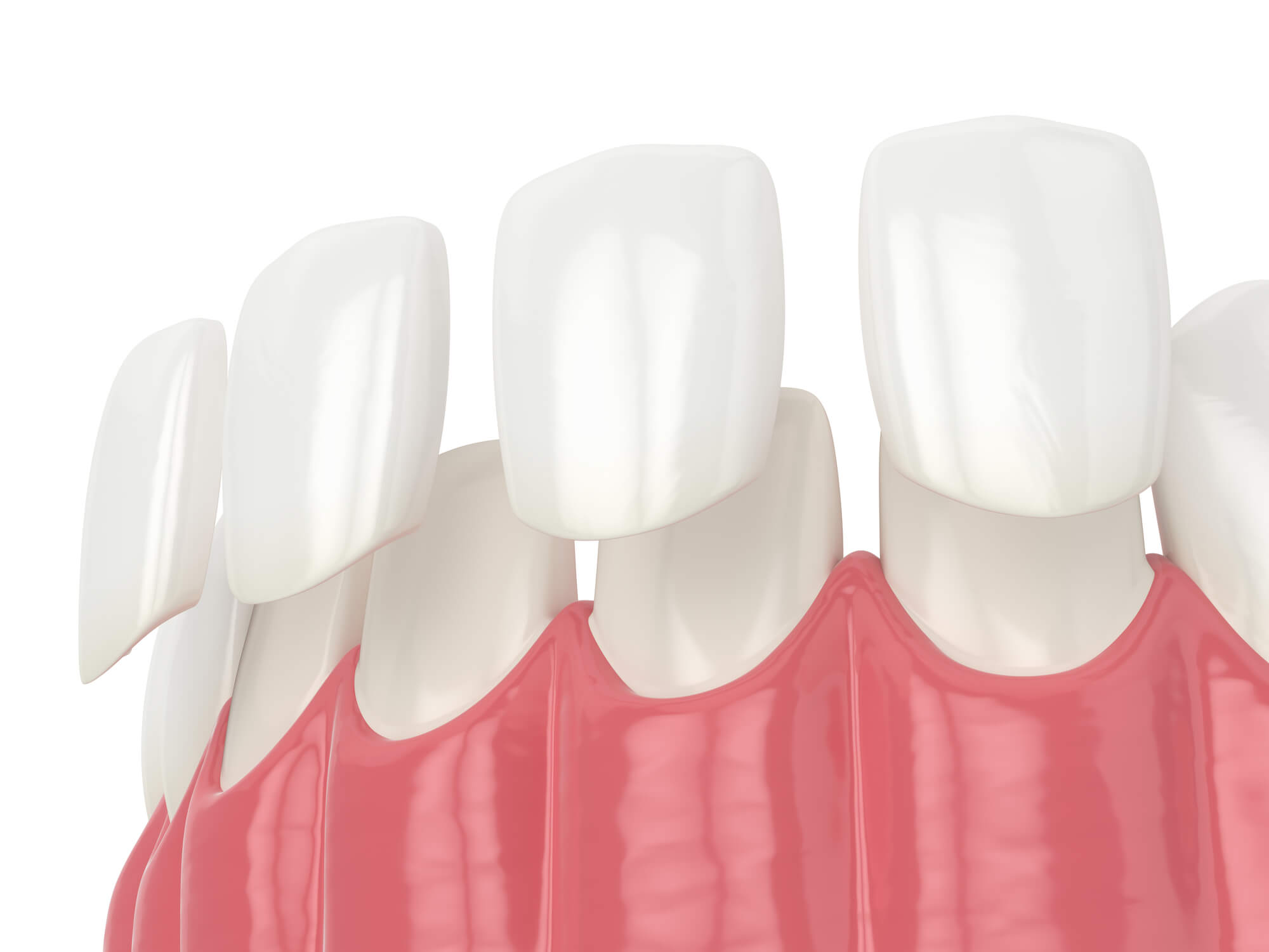 where can I find Boca Raton veneers?