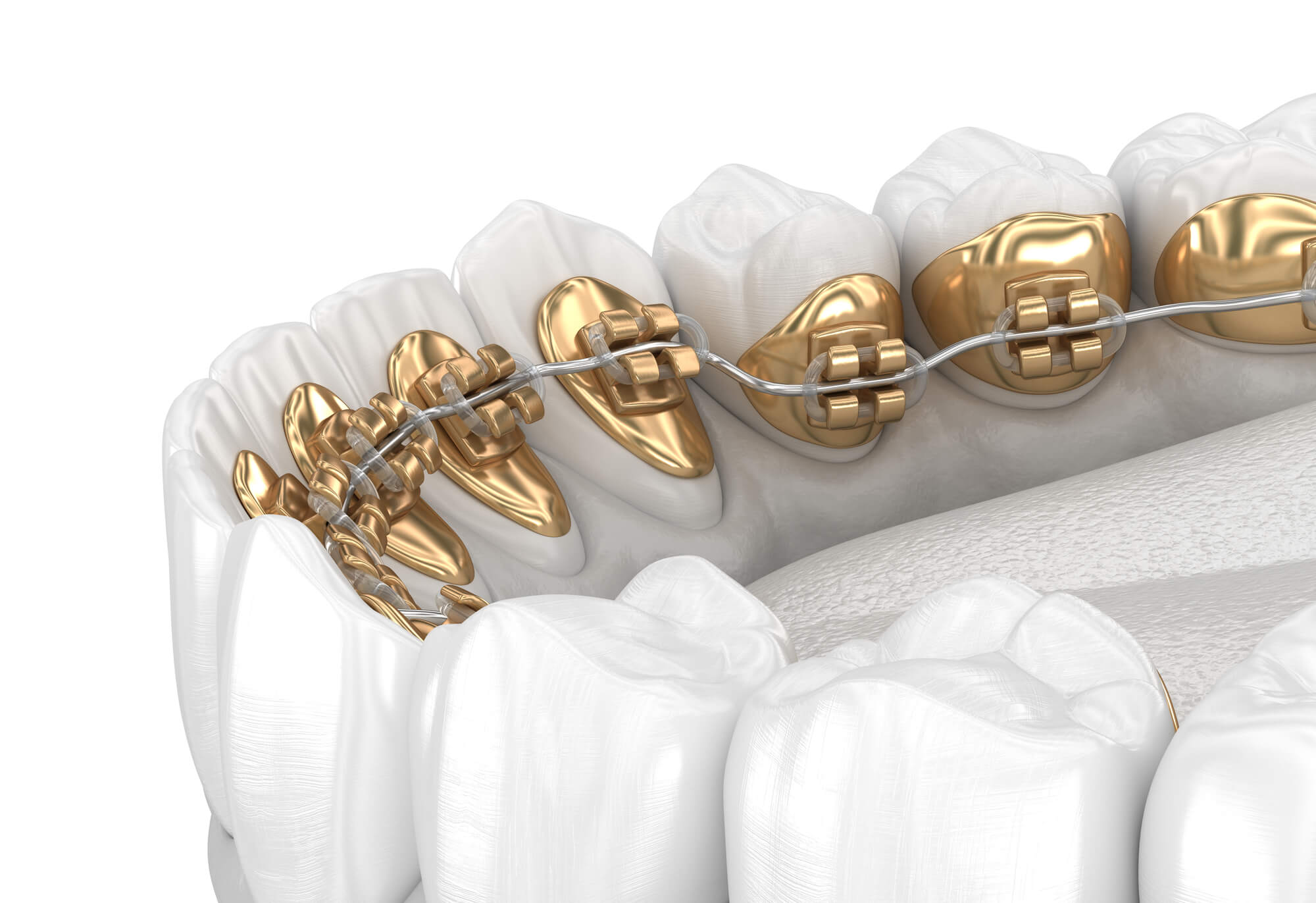 Do I need braces Boca Raton?