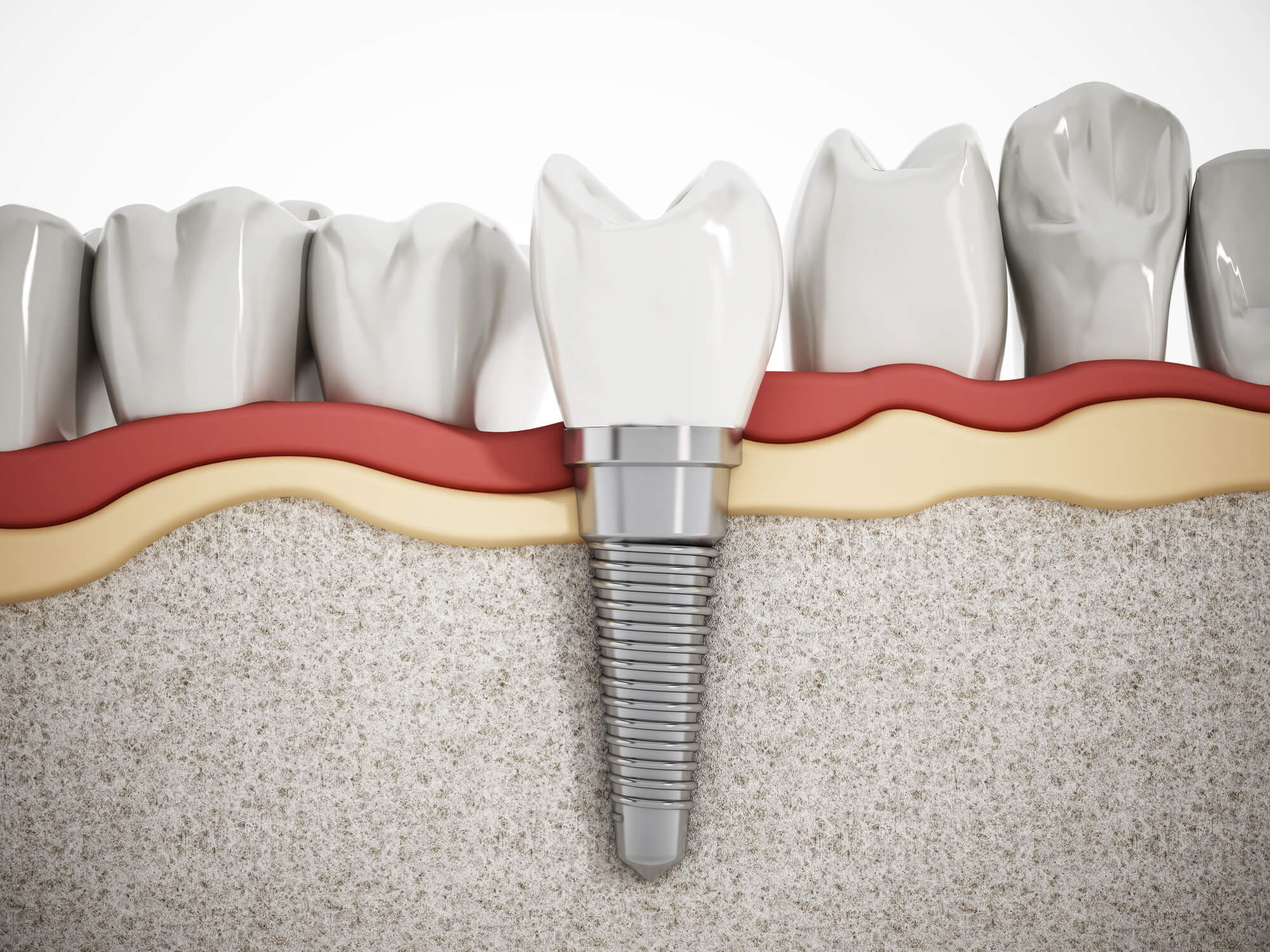 where can i get dental implants in fort pierce fl?