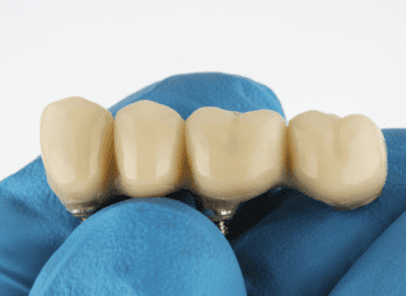 dental bridges 101: types, benefits, care, and more