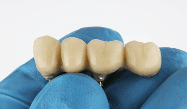 dental bridges 101: types, benefits, care, and more