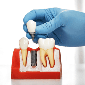 top benefits of dental implants