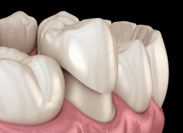 types of dental crowns