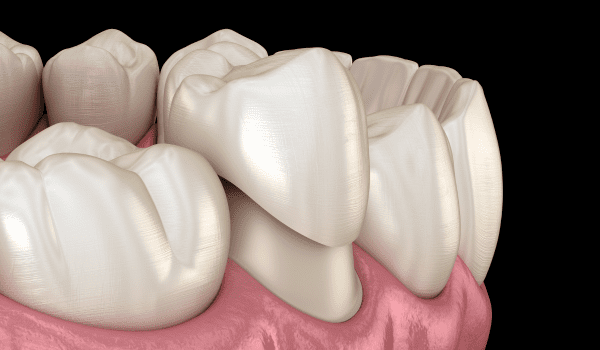 types of dental crowns