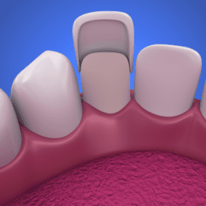 are veneers permanent