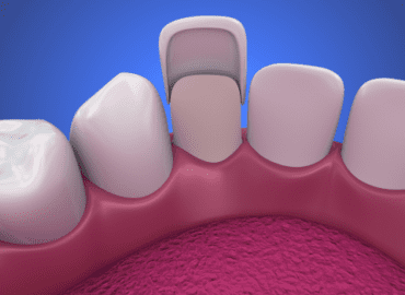 are veneers permanent