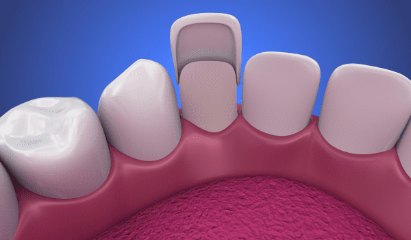 are veneers permanent