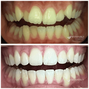 how to straighten teeth without braces - reasons to consider invisalign