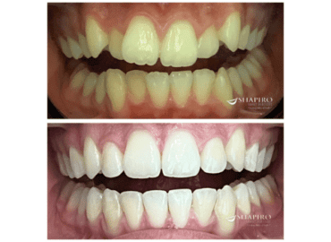 how to straighten teeth without braces - reasons to consider invisalign