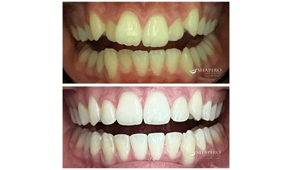 how to straighten teeth without braces - reasons to consider invisalign