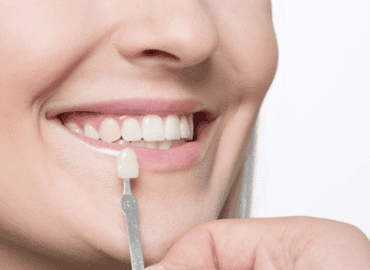 crowns vs veneers