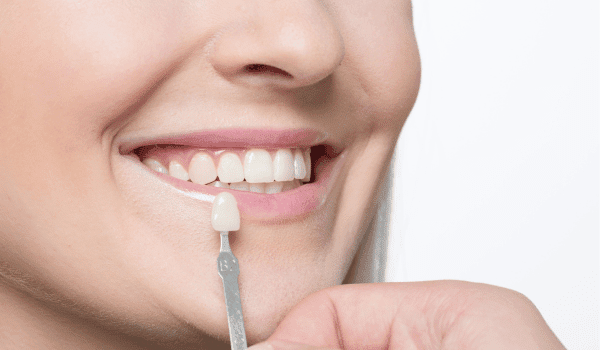 crowns vs veneers